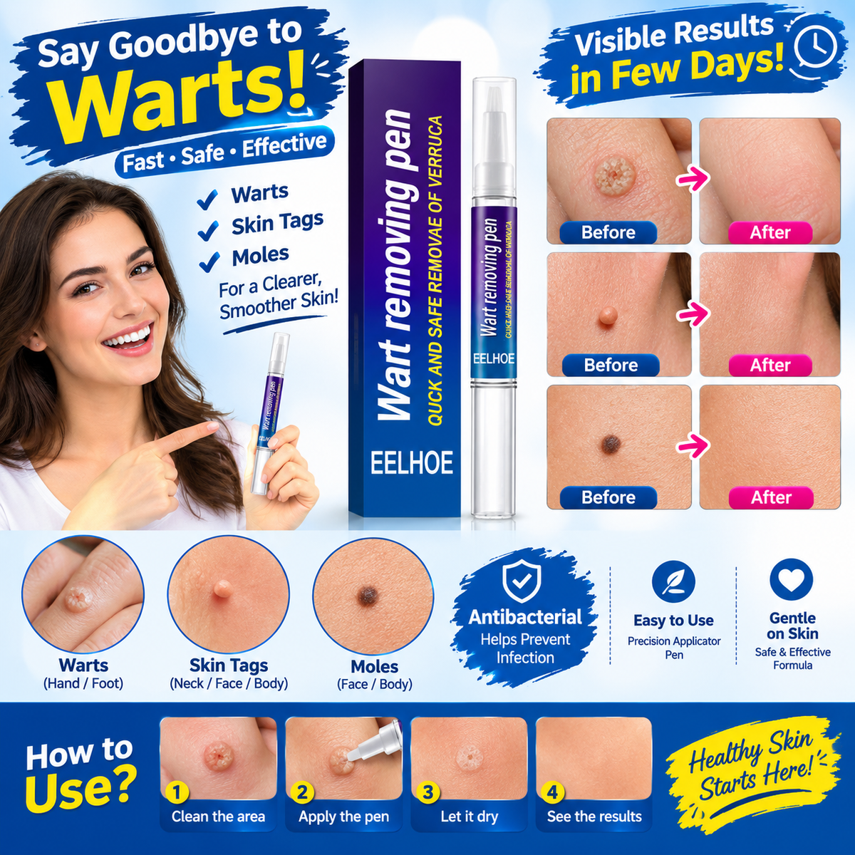 ๐ฉน Wart Remover Gel Pen โ Complete Shopify Product Listing